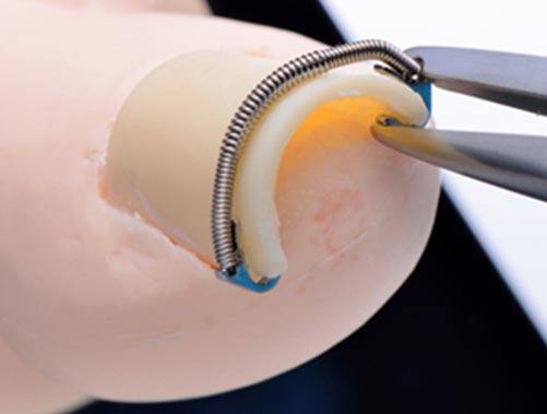 巻き爪マイスター